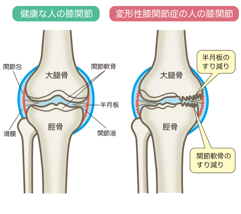 膝 の 力 が 抜ける 病気