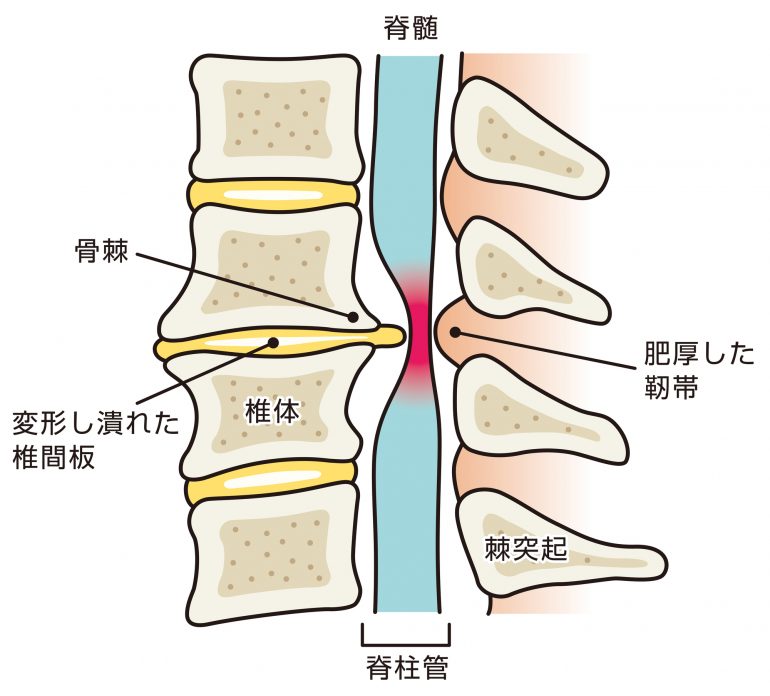 椎間板 ヘルニア 腕 の しびれ